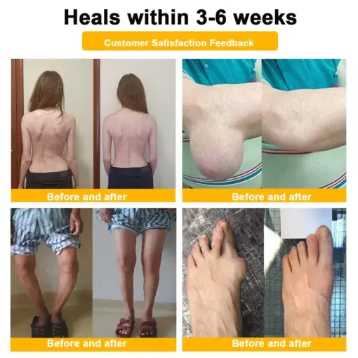 Seurico™ Botulinum Toxin & Bee Venom Pain-Relief Bone Healing Cream