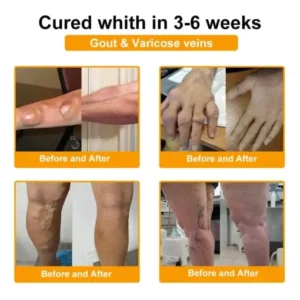 Seurico™ Botulinum Toxin & Bee Venom Pain-Relief Bone Healing Cream