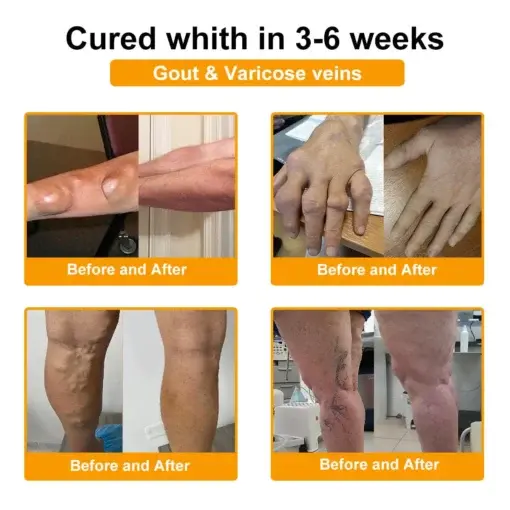 Seurico™ Botulinum Toxin & Bee Venom Pain-Relief Bone Healing Cream