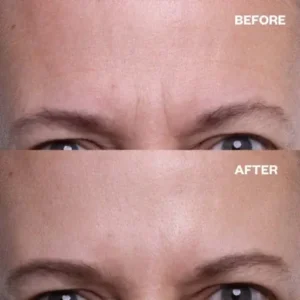 Seurico™ Forehead Wrinkle Patches