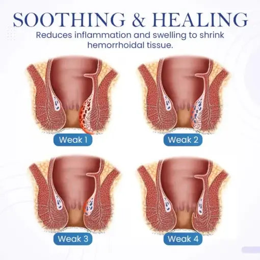 Seurico™ Herbal Hemorrhoid Treatment