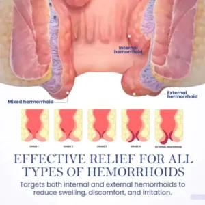 Seurico™ Herbal Hemorrhoid Treatment