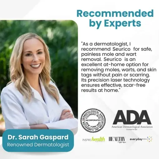 Seurico™ Laser Pen – Non-invasive Mole and Wart Removal