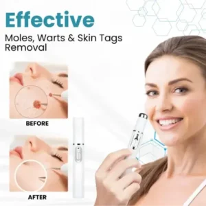 Seurico™ Laser Pen – Non-invasive Mole and Wart Removal