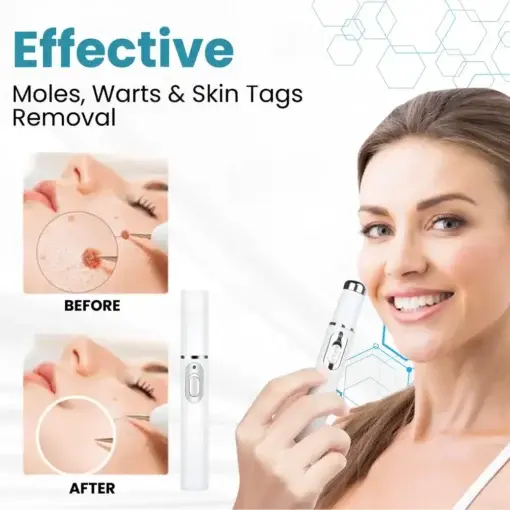 Seurico™ Laser Pen – Non-invasive Mole and Wart Removal