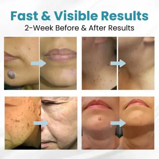 Seurico™ Laser Pen – Non-invasive Mole and Wart Removal