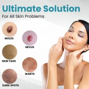Seurico™ Laser Pen – Non-invasive Mole and Wart Removal