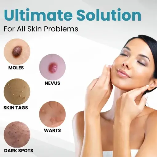 Seurico™ Laser Pen – Non-invasive Mole and Wart Removal