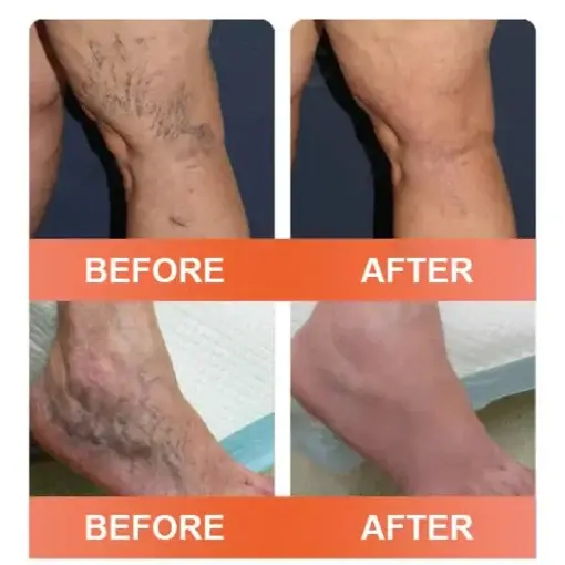 Seurico™ VeinEase Mikronadel-Therapie- Aufnaher