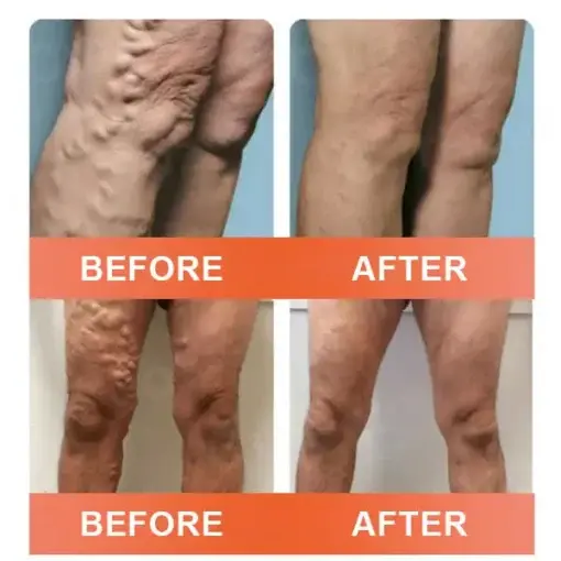 Seurico™ VeinEase Mikronadel-Therapie- Aufnaher