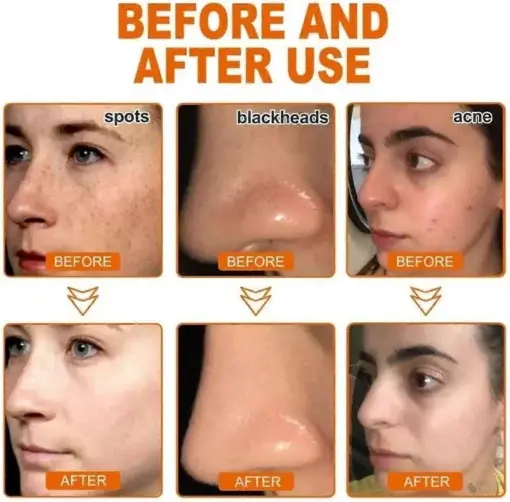 Seurico™ Whitening and Freckle – Removing Mask